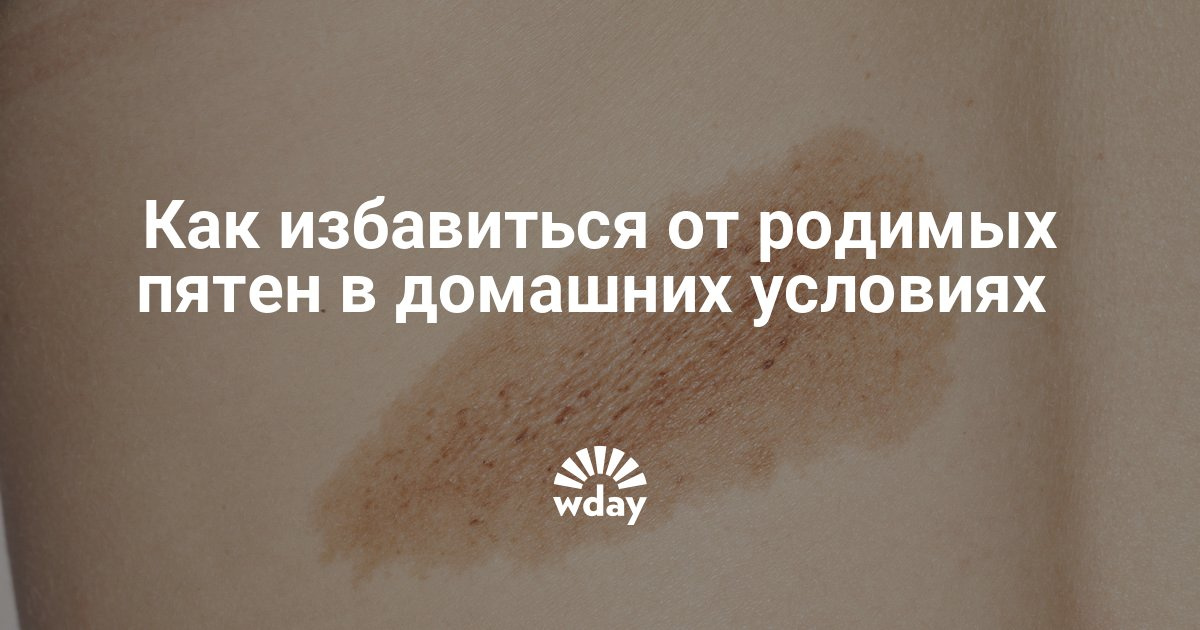 Родимое пятно как избавиться в домашних условиях Родимое пятно как избавиться в домашних условиях