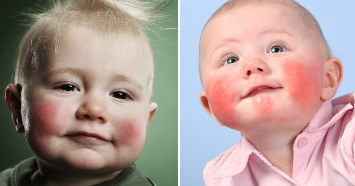 Методы диагностики атопического дерматита у детей