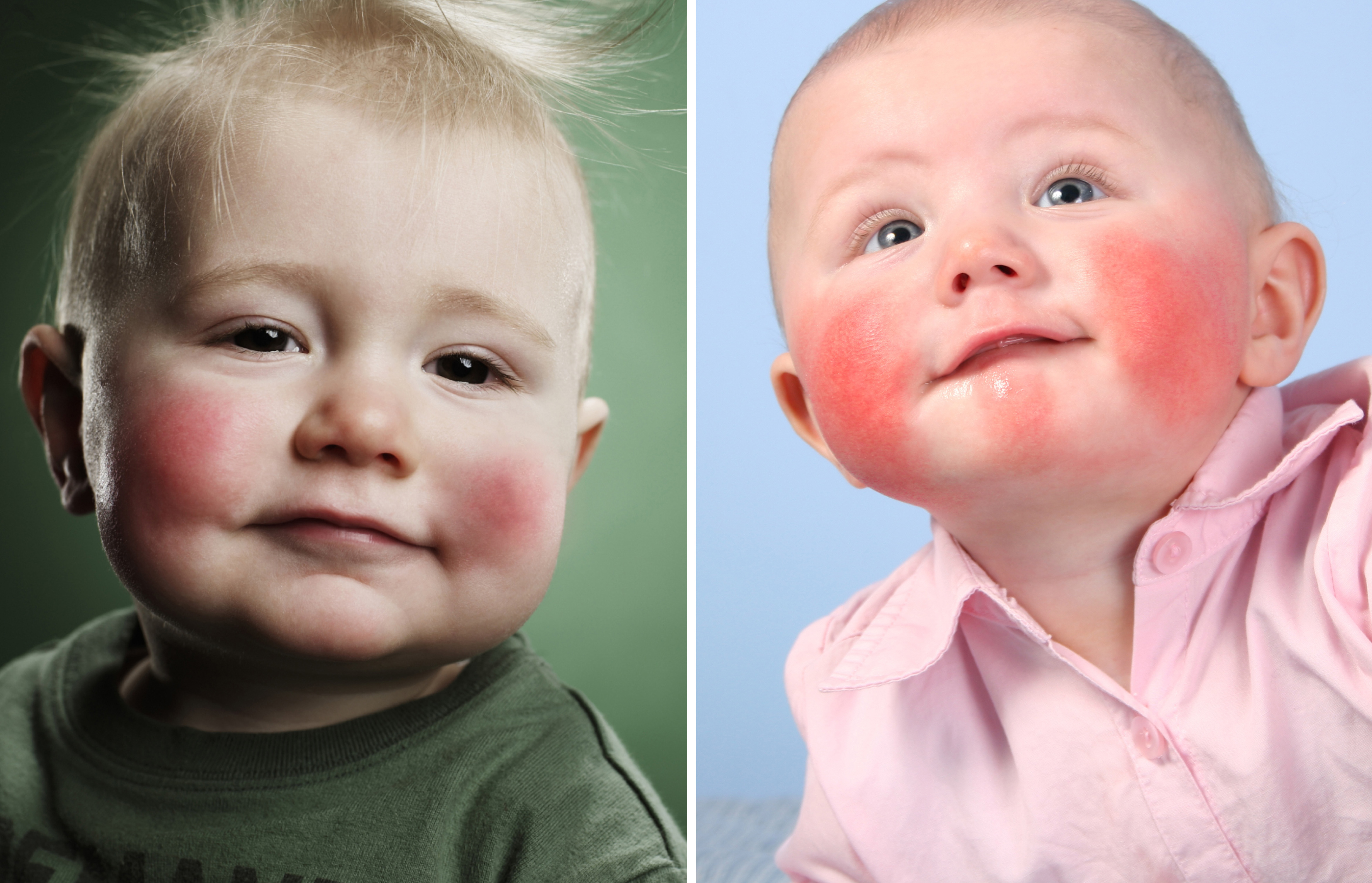 Диатез на лице у детей, аллергия, сыпь