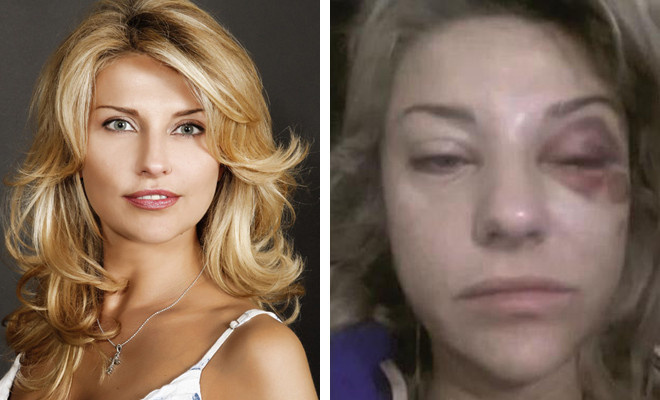 Жена Башарова Екатерина Архарова синяки фото Жена Башарова Екатерина Архарова синяки фото