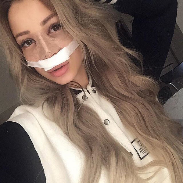 Екатерина Гужвинская сделала пластику носа после расставания с Вовой Гаути