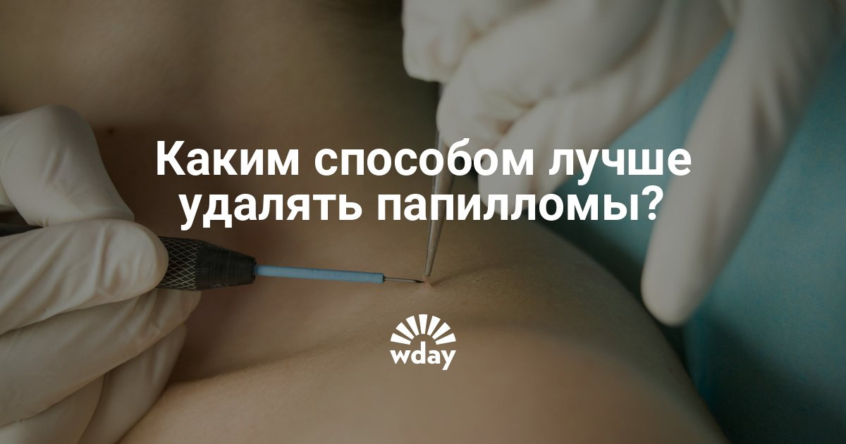 podpisalsya udalenie metod samiy papillom luchshiy svoevremenniy Самый лучший метод удаление папиллом фото