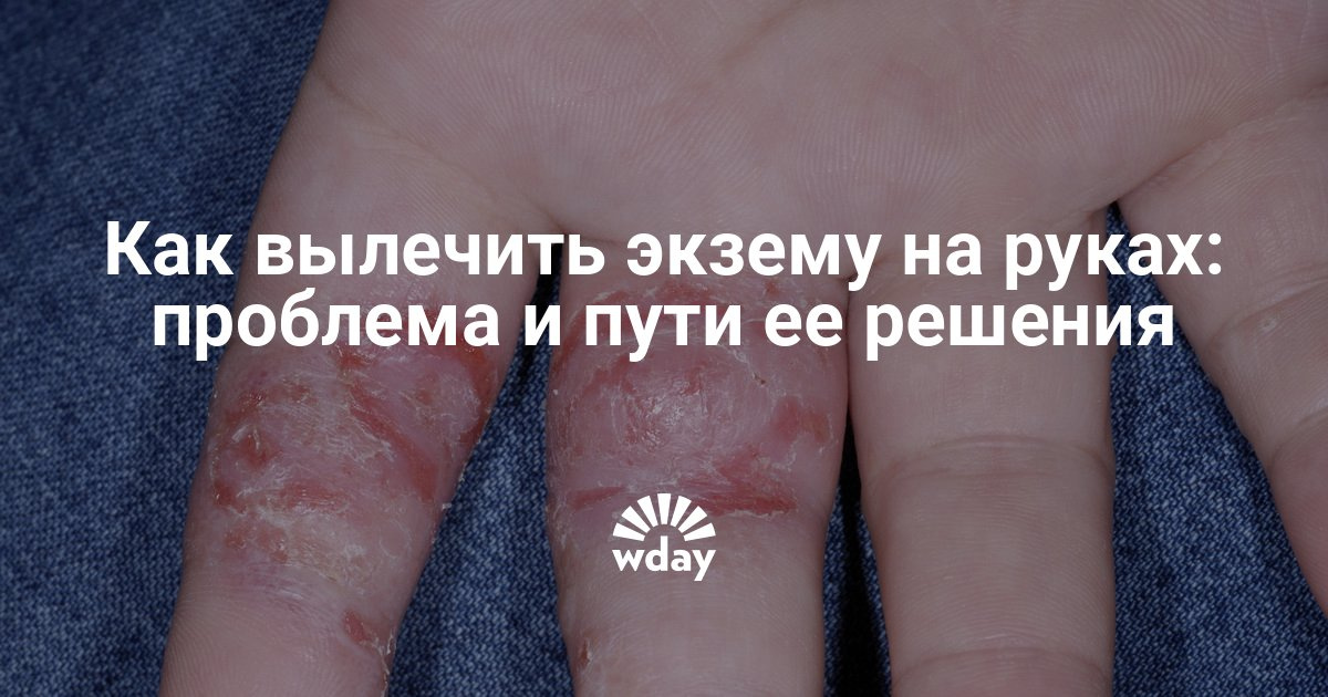 Экзема на руках чем лечить в домашних условиях отзывы Экзема на руках чем лечить в домашних условиях отзывы