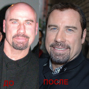Пересадка волос Пересадка волос