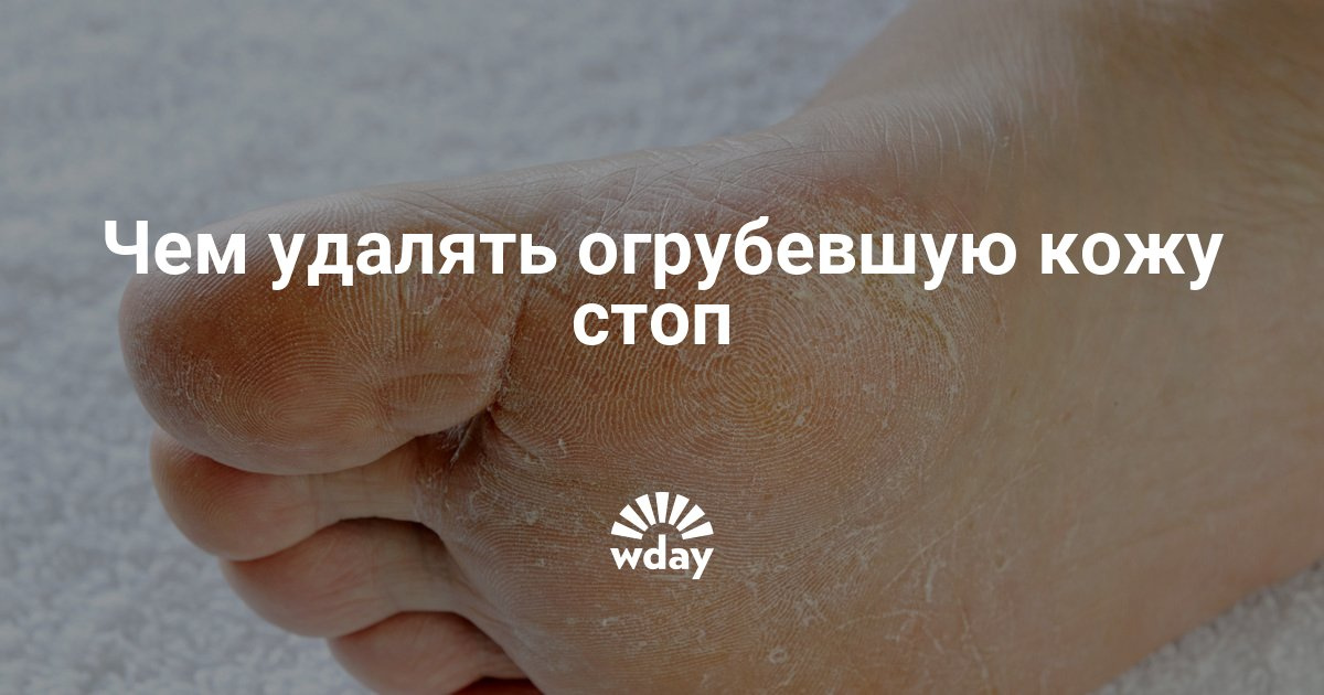 Чем убрать ороговевшую кожу на ногах Чем убрать ороговевшую кожу на ногах