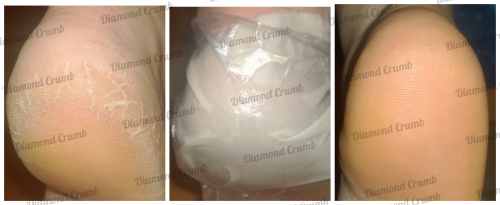 Рекомендация!!! Мозолин экспресс-педикюр Рекомендация!!! Мозолин экспресс-педикюр