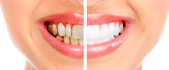 Хотите быстро и эффективно избавится от табачного налета? Хотите быстро и эффективно избавится от табачного налета?