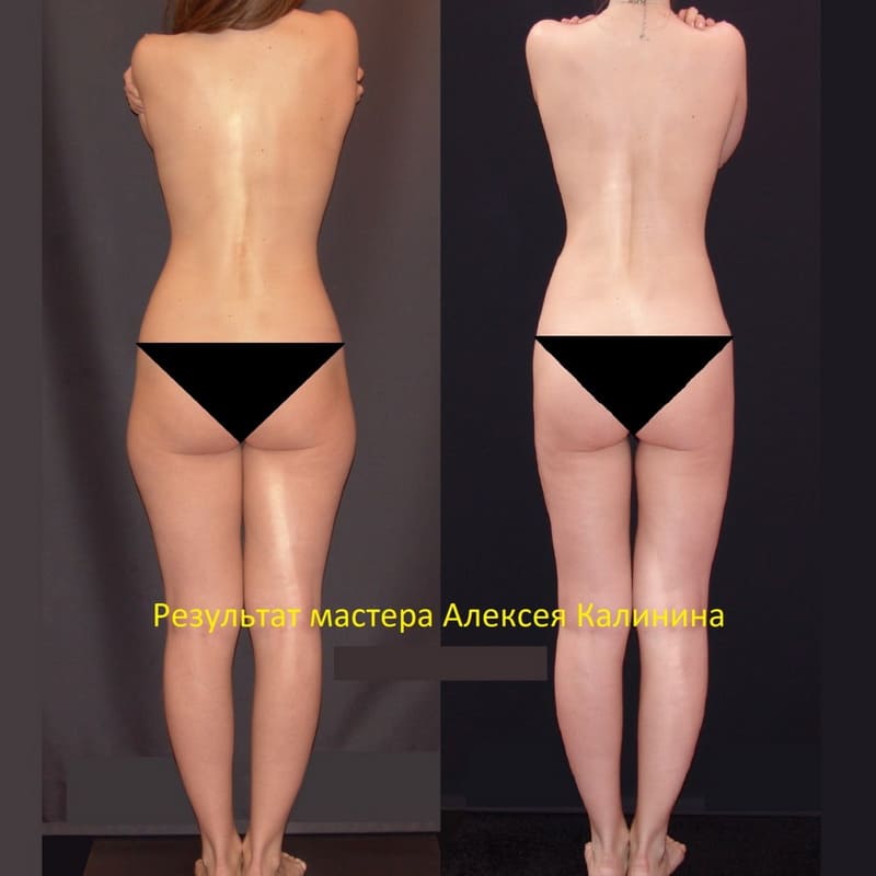 Преимущества ручной пластики среди других методов коррекции фигуры Преимущества ручной пластики среди других методов коррекции фигуры