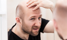 Андролог Андрей Лычагин назвал главную причину, почему мужчины лысеют