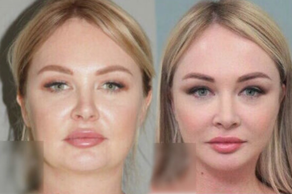 Лицо Дарьи Пынзарь до и после операции