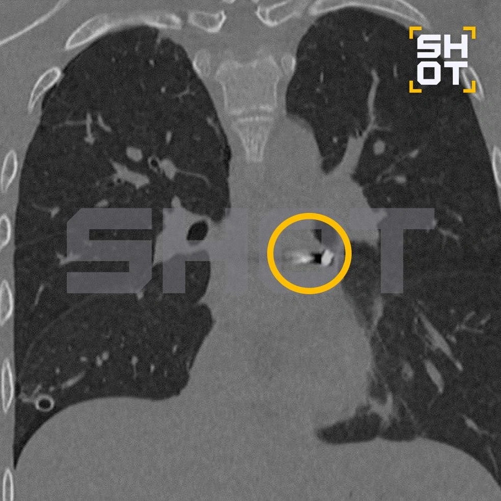 Пуля находилась рядом с сердцем | Источник: Shot / Telegram