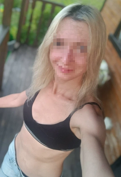 Анна попала в больницу с ожогами 80% тела