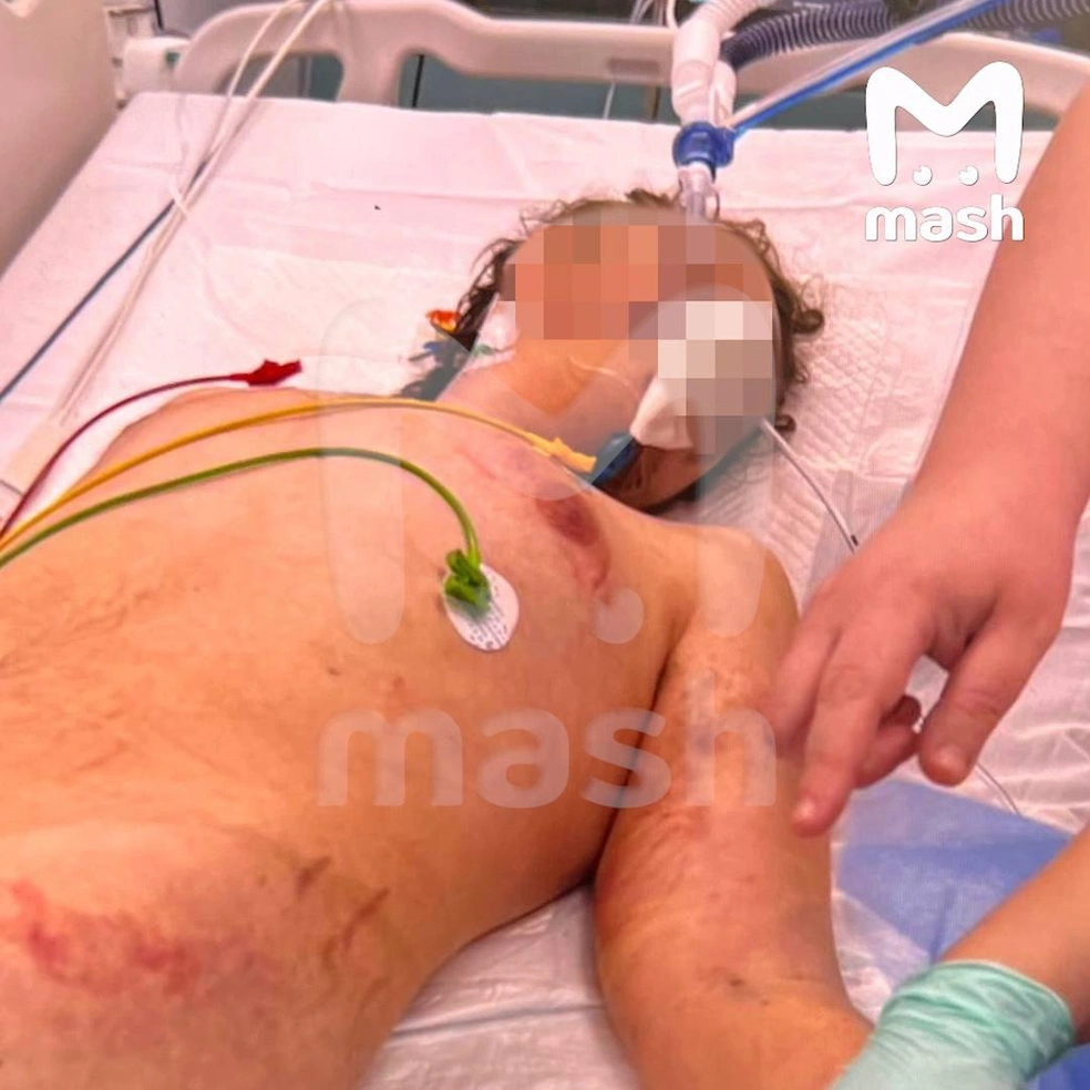 Повреждения на теле пострадавшего мальчика | Источник: Mash / T.me