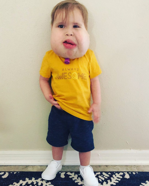 Как живет 2-летний малыш, родившийся с огромной челюстью из-за редкой генетической аномалии