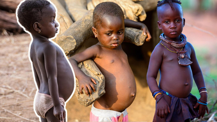 Почему у детей из Африки на самом деле такие большие животы
