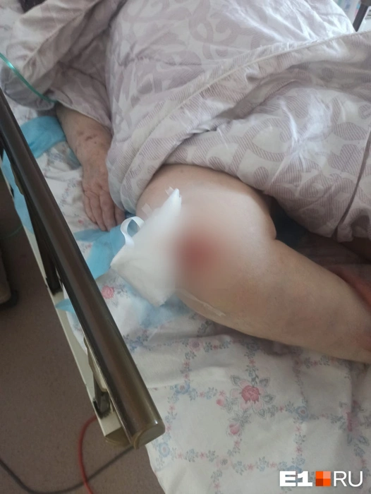 На ноге оказалась ссадина внушительных размеров. Также у пациентки нашли огромную язву (пролежень), но мы не публикуем фото по этическим соображениям | Источник: предоставлено родственниками пациентки