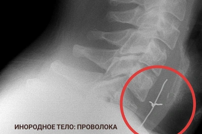 В Пятигорске из пациентов извлекли батарейки и коронки