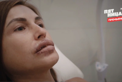 "I Couldn't Speak": Russian Women Nearly Disabled by Lip Augmentation
