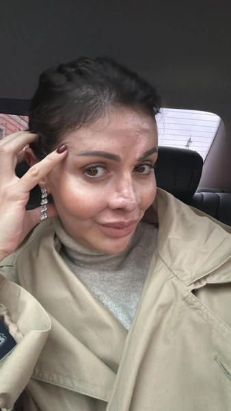 Алиса пережила не одну пластику, чтобы вернуть себе нос