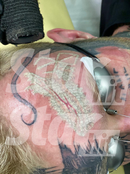 Денису удалили две татуировки за одну процедуру