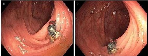 Муха в кишечнике (фото)