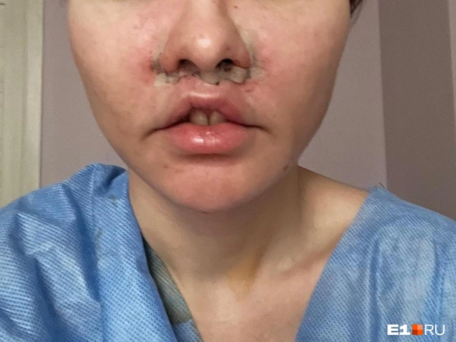 После операции пациентка была в ужасе от результата, но ее убеждали, что всё дело в отеке | Источник: предоставила пациентка