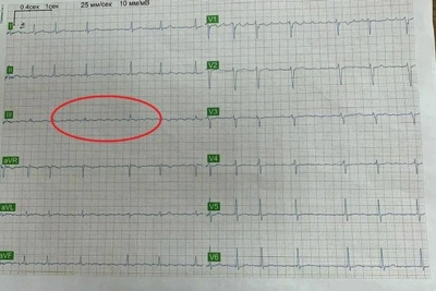 Объятие жены спасло жизнь мужчине в Воронеже