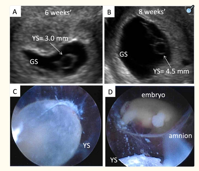 Источник: Научная работа «Early pregnancy ultrasound measurements and prediction of first trimester pregnancy loss: A logistic model»