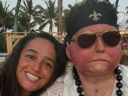 25-летний Джо Димео, перенесший первую в мире пересадку лица, сыграл свадьбу на Гавайях — кадры с церемонии