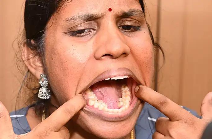 26-летняя индианка установила мировой рекорд по количеству зубов — угадаете, сколько их у Калпаны?