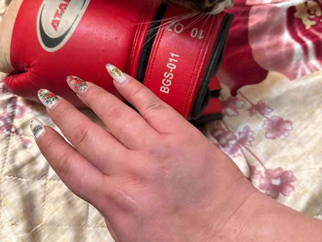 У девушки зафиксирован отёк правой кисти. | Источник: собеседница НГС