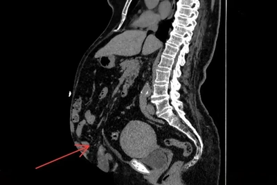 В Новгородской больнице прооперировали женщину с гигантской грыжей