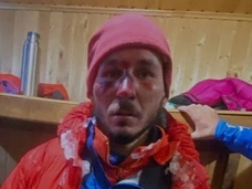 Жуткие фото альпинистов, выживших на Эльбрусе
