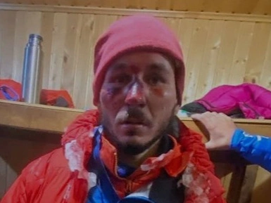 Жуткие фото альпинистов, выживших на Эльбрусе