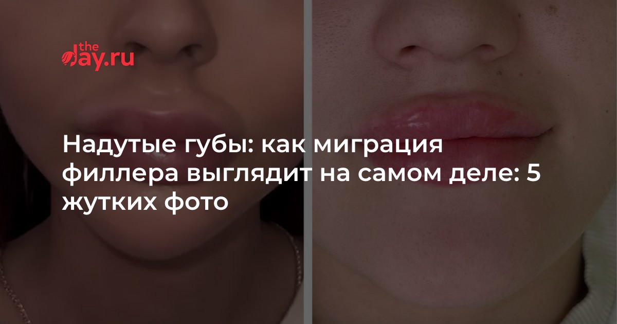 Как понять что филлер мигрировал