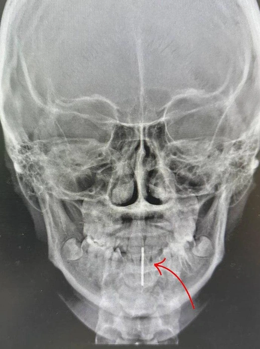 15-летней девочке вытаскивали украшение из языка в Ивано-Матренинской больнице | Источник: Ивано-Матренинская детская больница / T.me