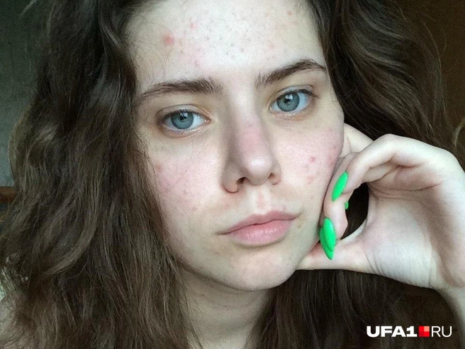 Делала фото, чтобы отслеживать состояние кожи | Источник: Яна Пяева / UFA1.RU