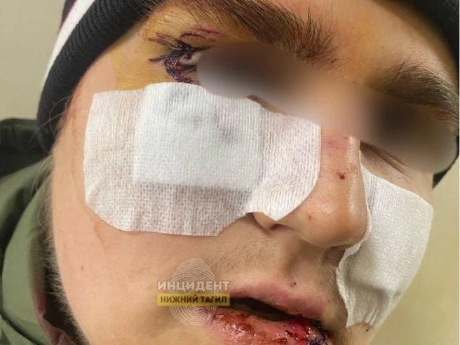 У пострадавшего диагностирована серьёзная травма в области глаз | Источник: «Инцидент Нижний Тагил»