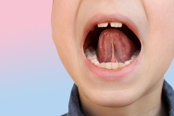Подрезание уздечки языка у детей: нужно ли делать и какой способ выбрать