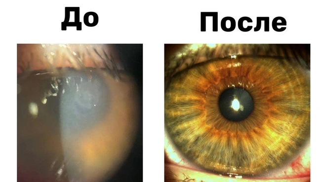 Глаза подростка после ежедневного ношения однодневных линз | Источник: Минздрав МО