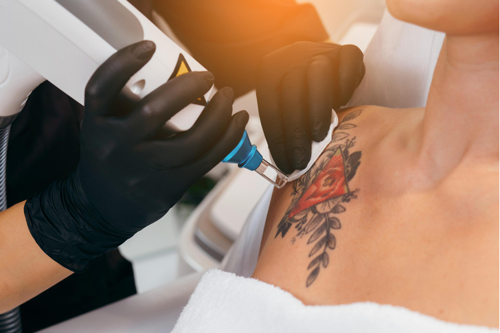 Сложно ли избавиться от татуировки