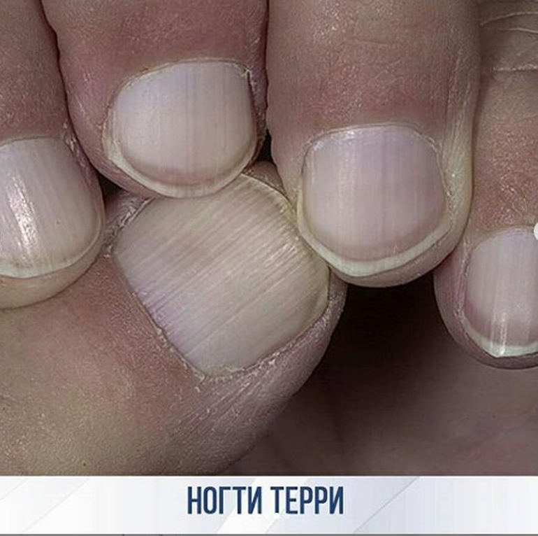 Почему появляются белые пятна на ногтях и что с этим делать