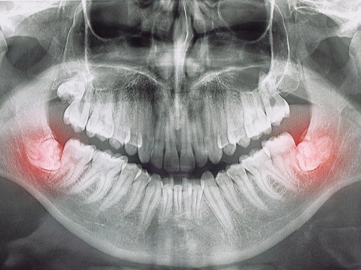 10 фактов о зубах мудрости, которые ты вряд ли знала