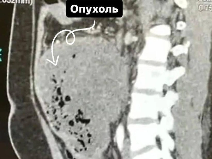 Врачи удалили у студента злокачественную опухоль, которую он принял за кишечную инфекцию