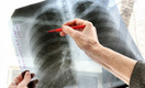 В России создадут единый регистр больных туберкулезом