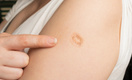 Считайте шрамы: как узнать, делали ли вам в детстве прививку от оспы