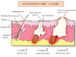 Болезнь акне: как развивается угревая сыпь?