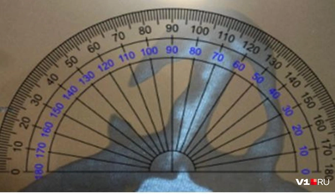 Томография носа после первой операции показывала отклонение на 20 градусов | Источник: Артем Кулиев