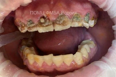 Student Nearly Loses Teeth After Two Weeks of Energy Drinks