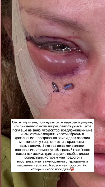 Так Рита Дакота выглядела после операции